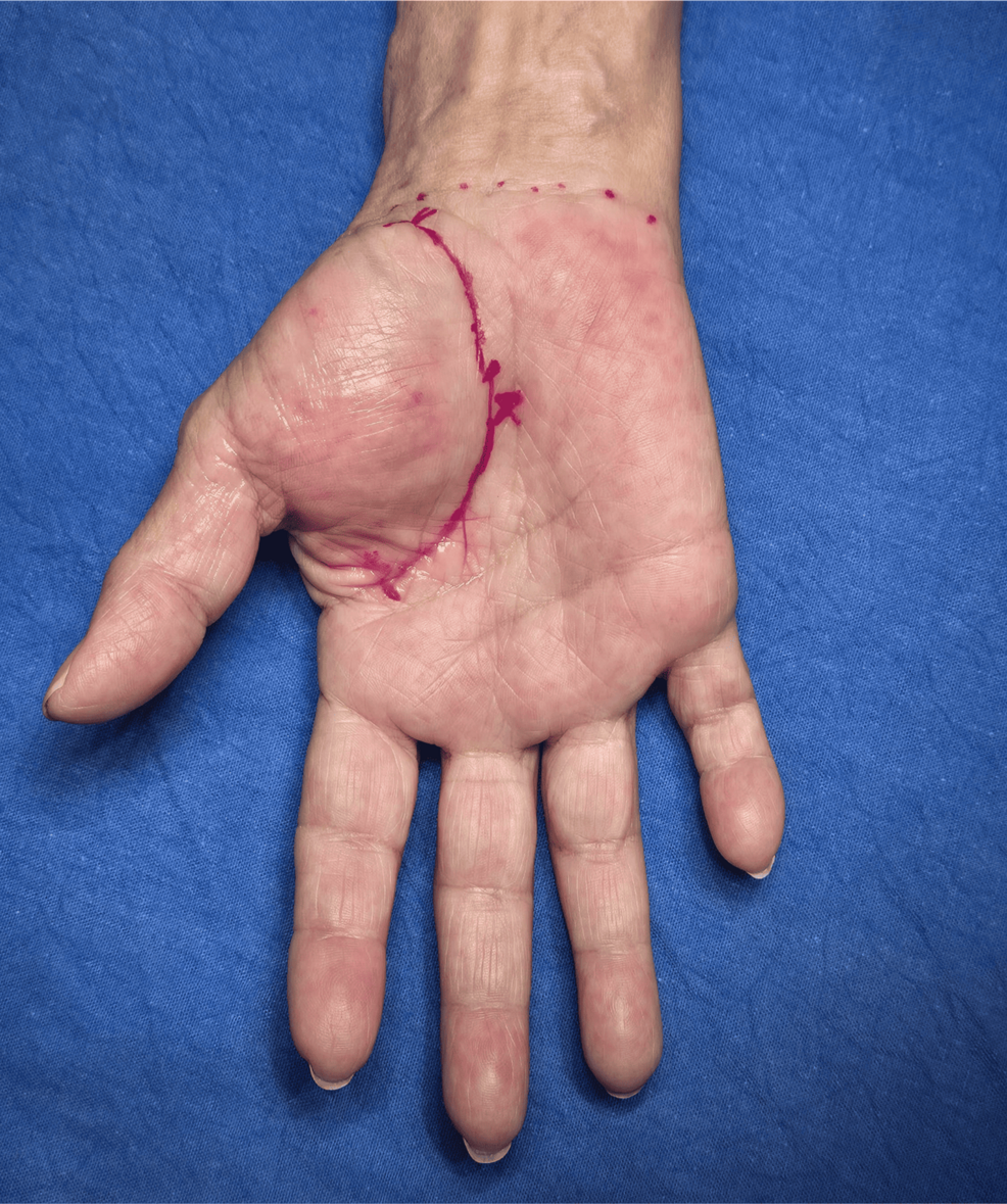Giant Lipoma of the Thumb Pad in a Confined Space: A Clinical Case