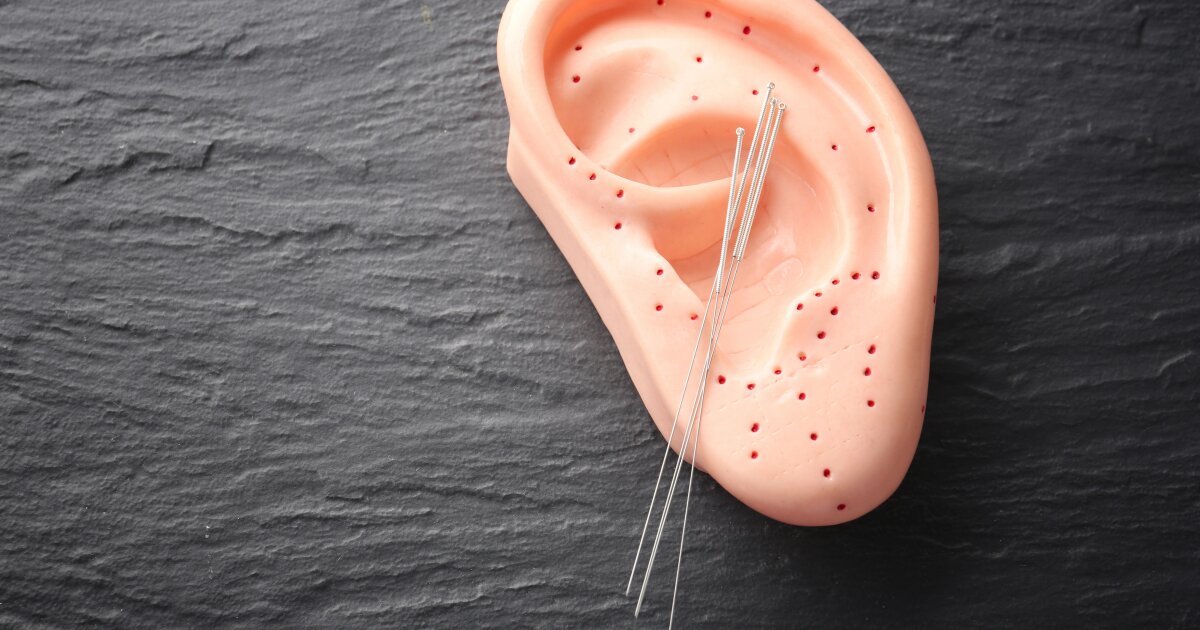 Migraine pain drops after targeted ear acupuncture