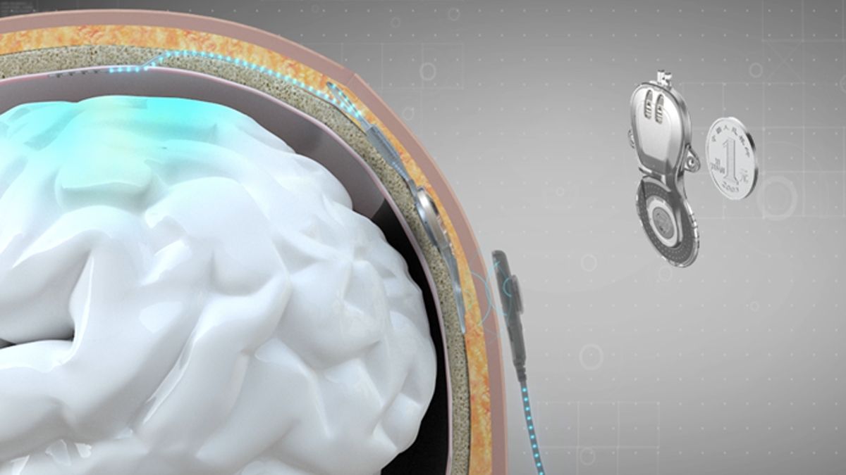 China completes the world’s first commercial brain-chip implant, beating Elon Musk’s Neuralink to market with the coin-sized NEO device